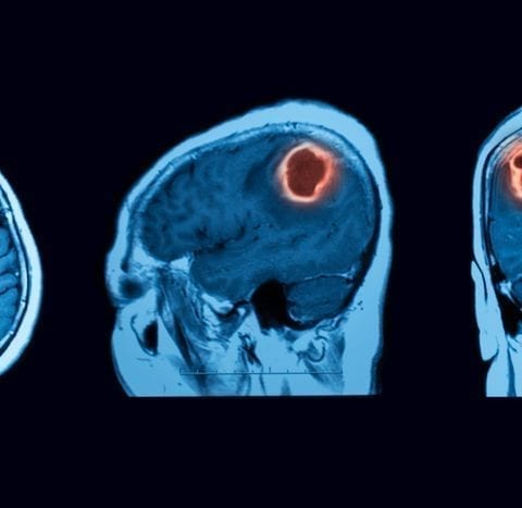 Tratamiento del cáncer cerebral:¿Esperanza para los glioblastomas?