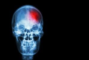 Derrame cerebral: qué es, causas, síntomas y tratamiento.