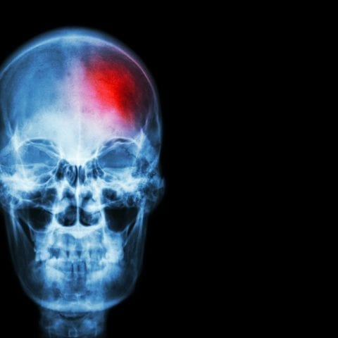 Derrame cerebral: qué es, causas, síntomas y tratamiento.