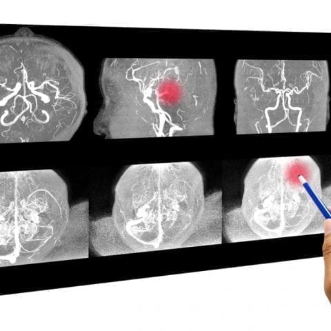 Cómo tratar un tumor cerebral:  prueban un tipo de radioterapia que causa menos efectos secundarios