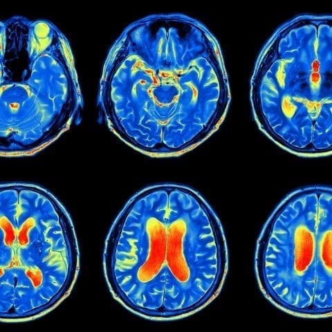 Brain scans may one day be used to predict dementia