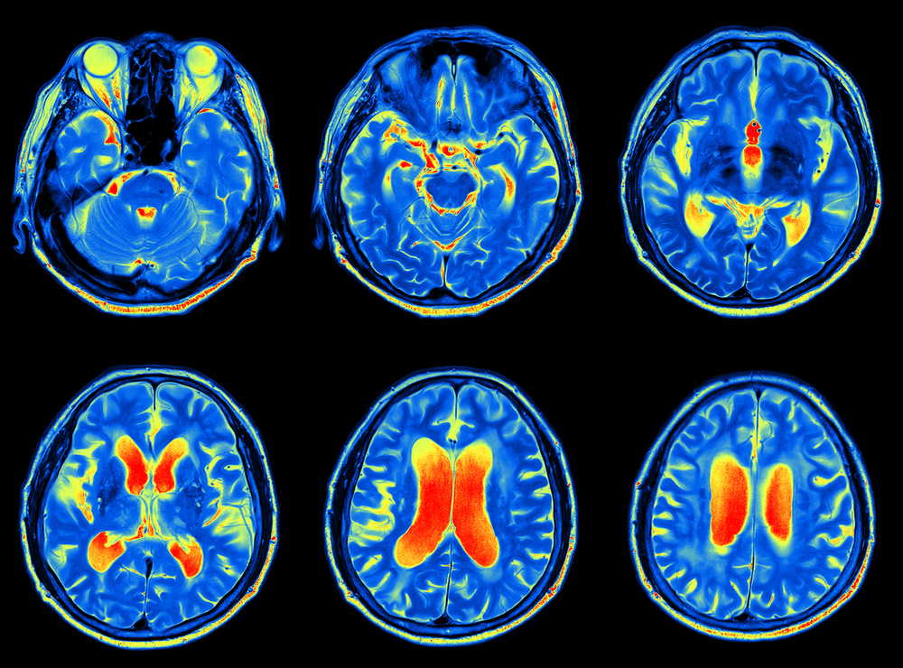 brain-scans-may-one-day-be-used-to-predict-dementia-health-brain-and