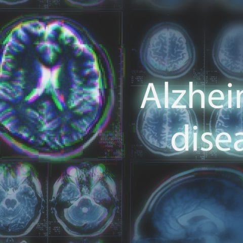 Alzheimer’s signs show in young brain